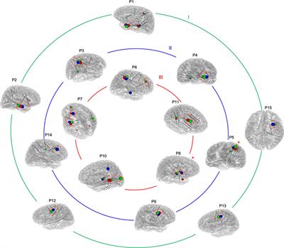 Localization of the Epileptogenic Zone by Multimodal Neuroimaging and High-Frequency Oscillation